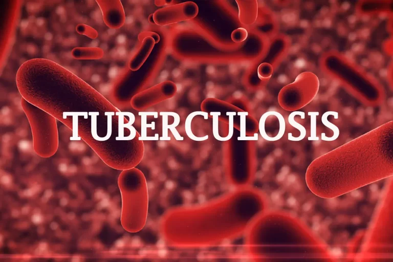 Nigeria in urgent need of TB agency