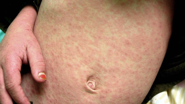 A measles outbreak has been declared in eight Nigerian states.