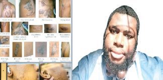 How we live above stigma, emotional distress– Nigerians with keloids