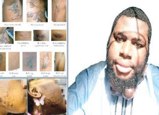 How we live above stigma, emotional distress– Nigerians with keloids