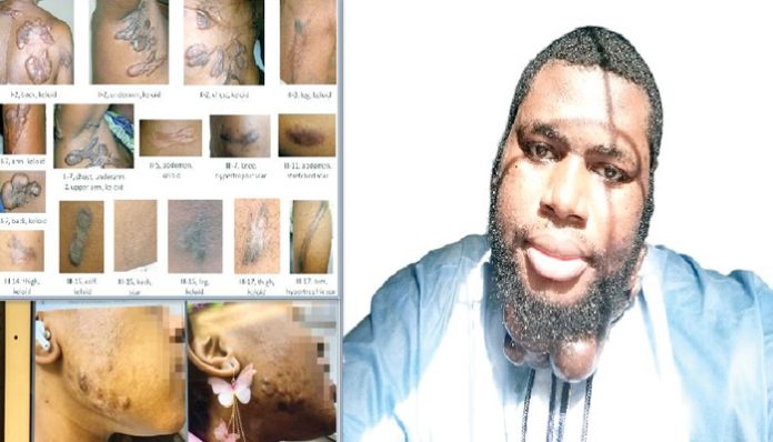 How we live above stigma, emotional distress– Nigerians with keloids