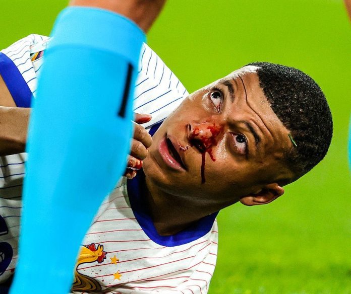 Euro 2024: Mbappe suffers broken nose