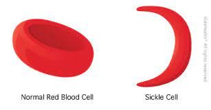 Sickle cell survivor advocates mandatory testing for intending couple