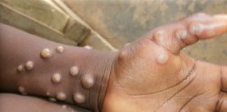 Burundi records first three mpox cases