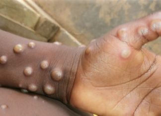 Burundi records first three mpox cases