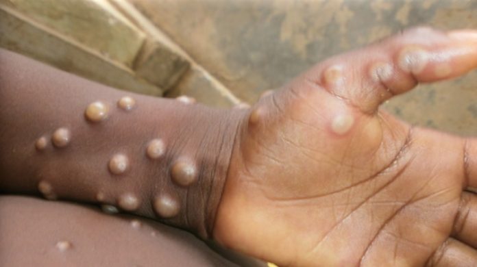 Burundi records first three mpox cases